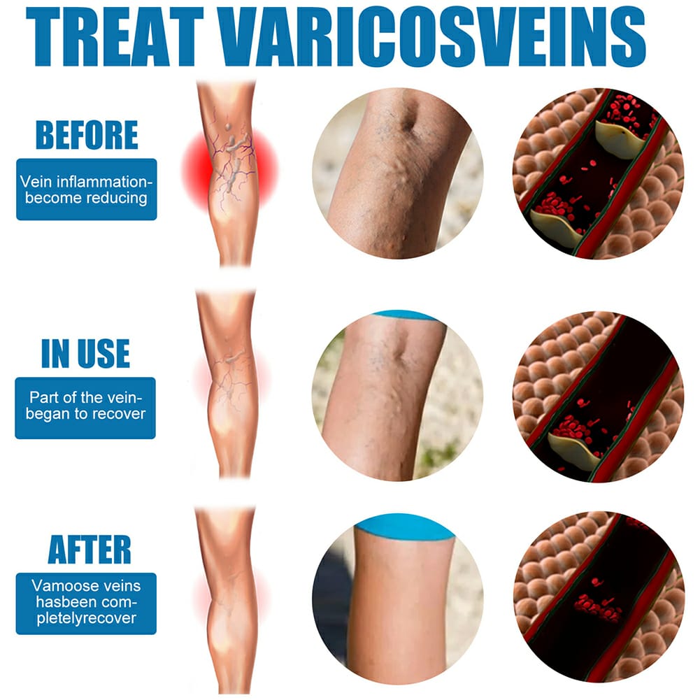 Vein Therapy Spray – Reduce Swelling & Pain Fast