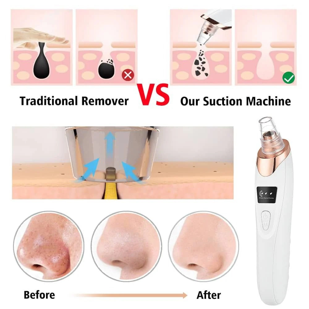 Acne & Blackhead Remover – Electric Pore Cleaner Vacuum